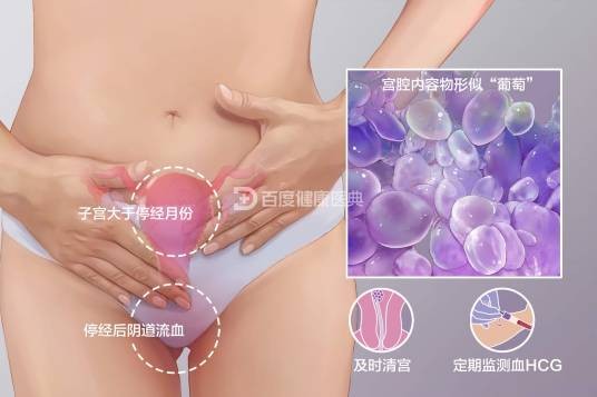 葡萄胎