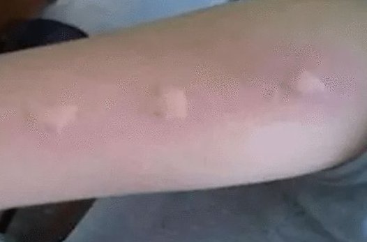 被蚊子咬了发朋友圈的搞笑句子有哪些?