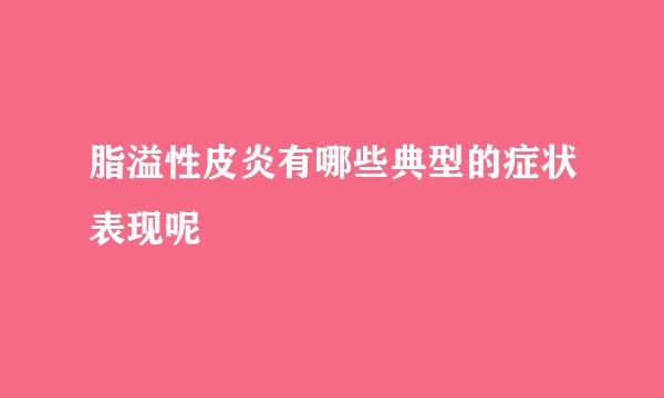 脂溢性皮炎有哪些典型的症状表现呢