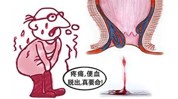 痔疮内疮的症状图片