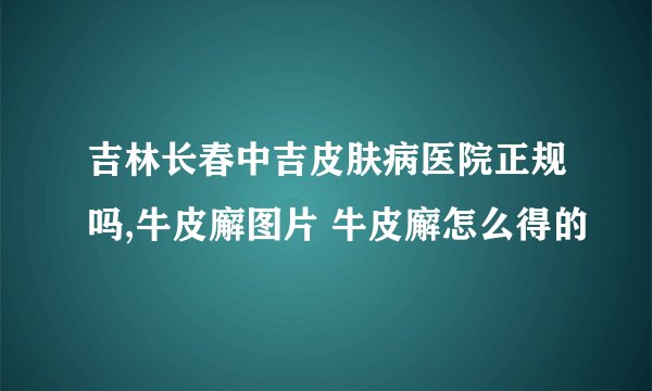 吉林长春中吉皮肤病医院正规吗,牛皮廨图片 牛皮廨怎么得的