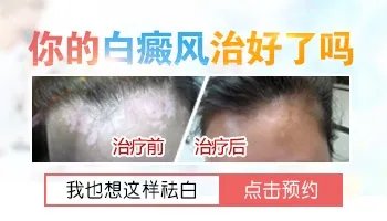 邯郸市远大白癜风医院男性治疗方法