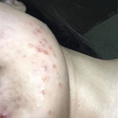 脸上长痘痘 怎么办