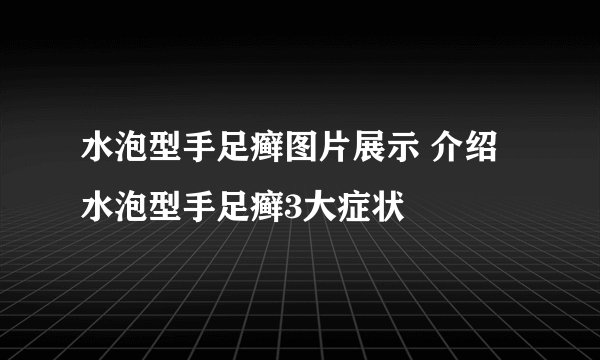 水泡型手足癣图片展示 介绍水泡型手足癣3大症状