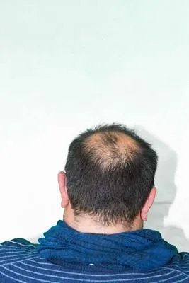头顶撞了个包应该怎么办才好 头顶撞了个包的民间消肿偏方