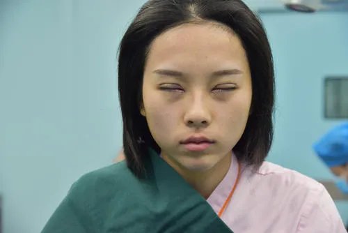 女子割双眼皮失败老公闹离婚，双眼皮手术哪种情况下算是很成功？