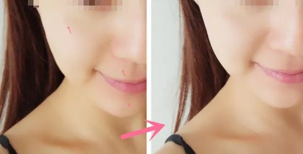 苏州做面部吸脂好的医院是哪家?