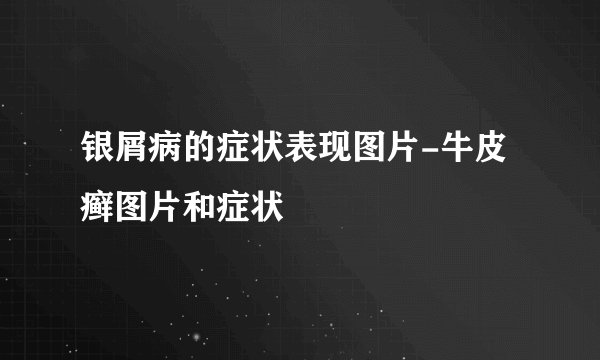 银屑病的症状表现图片-牛皮癣图片和症状