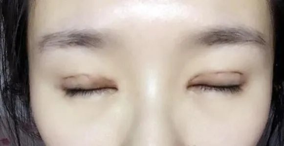 女子割双眼皮失败老公闹离婚,双眼皮手术哪种情况下算是很成功?