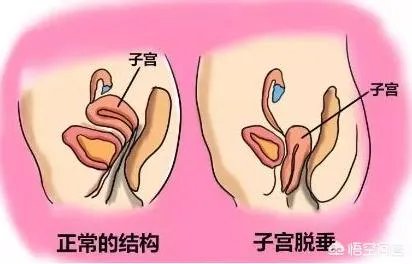 为什么现在越来越多的产妇会去做产后恢复？