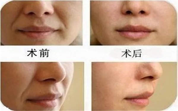 保妥适去皱的用量