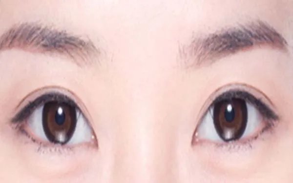 割眼角一般要多少钱