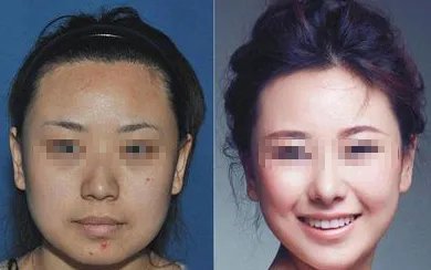 苏州做面部吸脂好的医院是哪家?