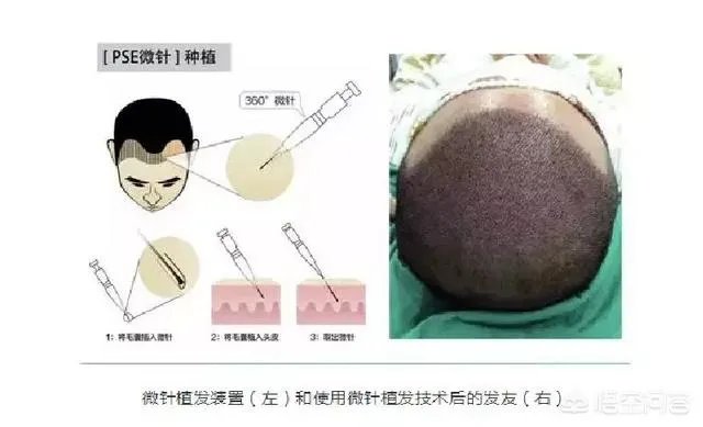 鲁尼植发大概花了多少钱?